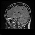 Amnestic syndrome secondary to hypoxic brain injury (Radiopaedia 24743-25004 D 14).jpg