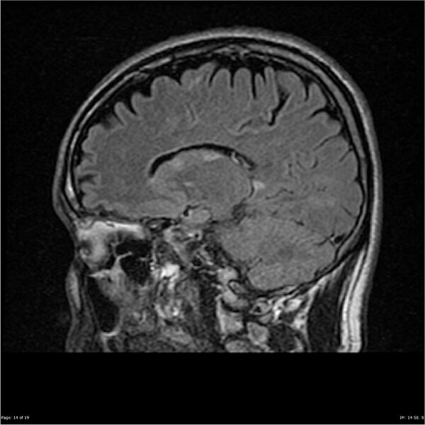 File:Amnestic syndrome secondary to hypoxic brain injury (Radiopaedia 24743-25004 D 14).jpg