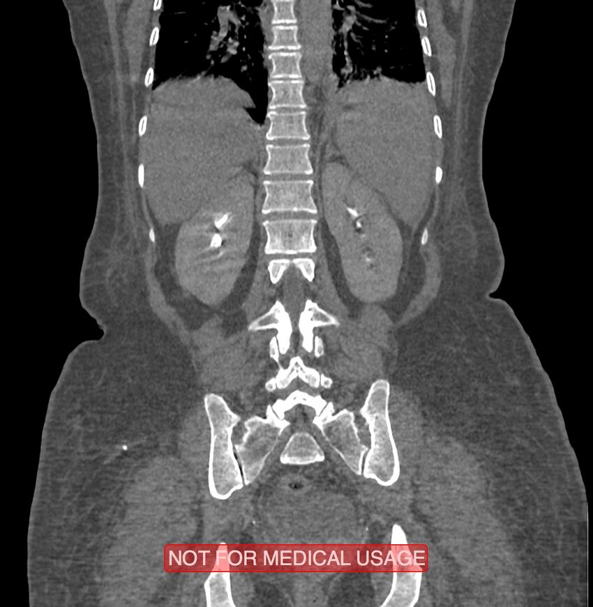 Amoebic enterocolitis with liver abscess (Radiopaedia 35100-36609 B 150).jpg