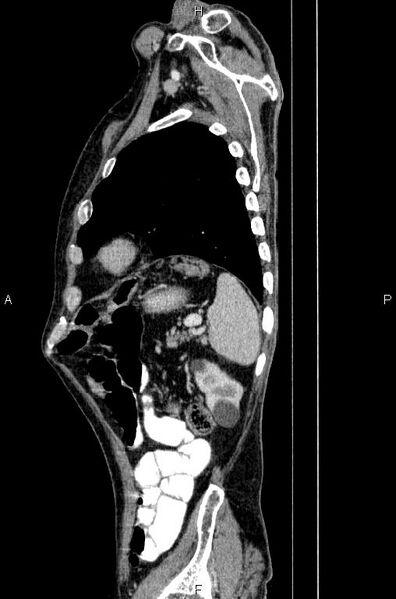 File:Ampullary adenocarcinoma (Radiopaedia 86093-102033 E 76).jpg