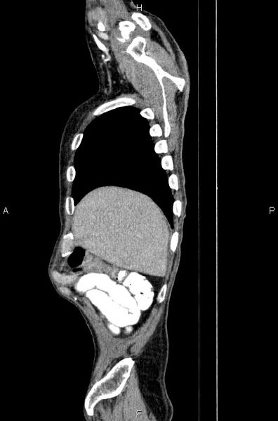 File:Ampullary adenocarcinoma (Radiopaedia 86093-102033 E 9).jpg