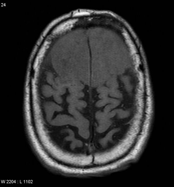 File:Anaplastic meningioma (Radiopaedia 5553-7290 Axial T1 1).jpg