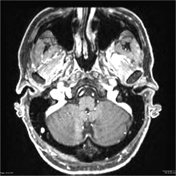 File:Anaplastic meningioma with recurrence (Radiopaedia 34452-35788 Axial T1 C+ 18).jpg