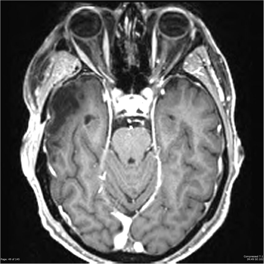 Anaplastic meningioma with recurrence (Radiopaedia 34452-35788 Axial T1 C+ 49).jpg