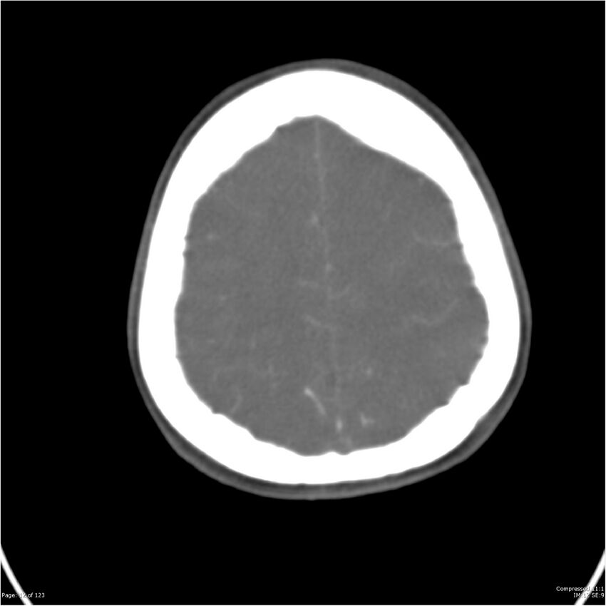 Aneurysmal subarachnoid hemorrhage and Moya Moya disease (Radiopaedia 34306-35593 Axial CT COW 12).jpg