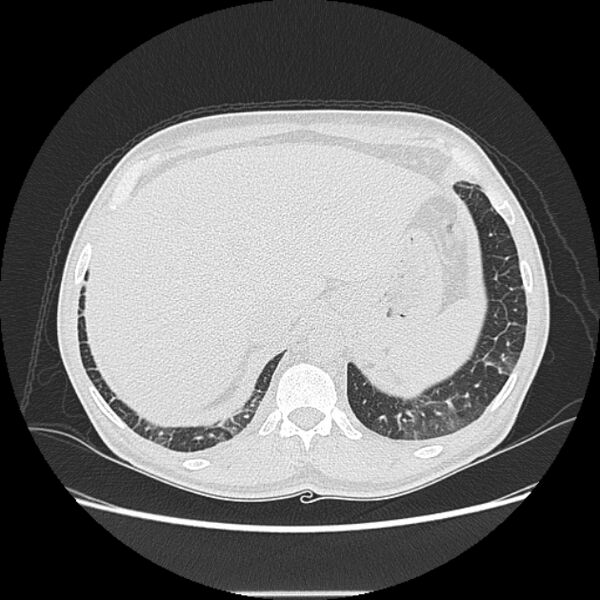 File:Angioinvasive aspergellosis (Radiopaedia 66995-76315 Axial lung window 47).jpg