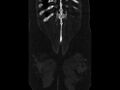 Ankylosing spondylitis (Radiopaedia 44609-48357 Coronal bone window 101).jpg