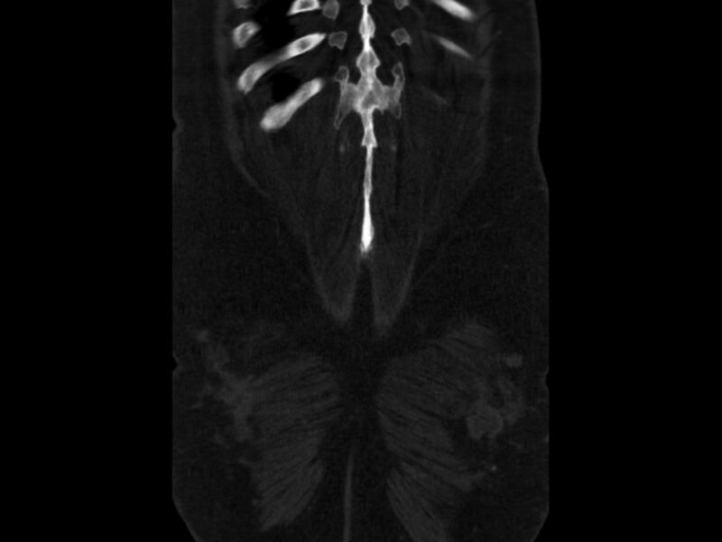 File:Ankylosing spondylitis (Radiopaedia 44609-48357 Coronal bone window 101).jpg