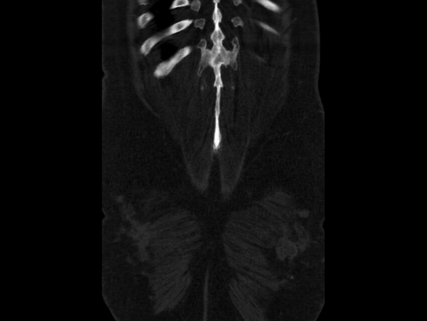Ankylosing spondylitis (Radiopaedia 44609-48357 Coronal bone window 101).jpg