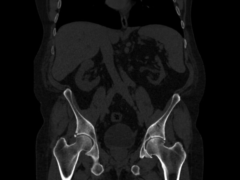 File:Ankylosing spondylitis (Radiopaedia 44609-48357 Coronal bone window 34).jpg