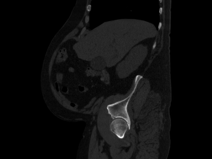 Ankylosing spondylitis (Radiopaedia 44609-48357 Sagittal bone window 19).jpg