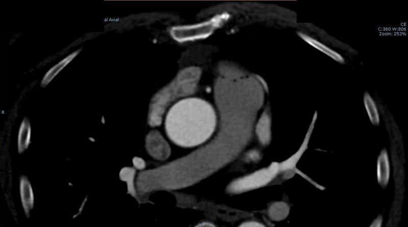 File:Anomalous left coronary artery- prepulmonic course (Radiopaedia 29253-29667 A 4).JPG