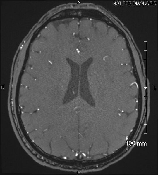 File:Anterior cerebral artery aneurysm (Radiopaedia 80683-94127 Axial MRA 157).jpg