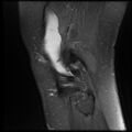 Anterior cruciate ligament tear, Wrisberg rip and bucket-handle tear of medial meniscus (Radiopaedia 75872-87266 Sagittal PD fat sat 3).jpg