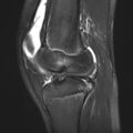 Anterior cruciate ligament tear - pediatric (Radiopaedia 62152-70260 Sagittal PD fat sat 21).jpg