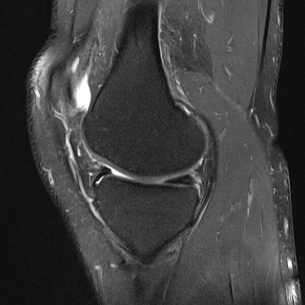 File:Anterior cruciate ligament tear - ramp lesion (Radiopaedia 71883-82322 Sagittal PD fat sat 17).jpg