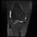 Anterior cruciate ligament tear with posteromedial corner injury, bucket-handle meniscal tear and chondral delamination (Radiopaedia 75501-86744 Coronal PD fat sat 9).jpg