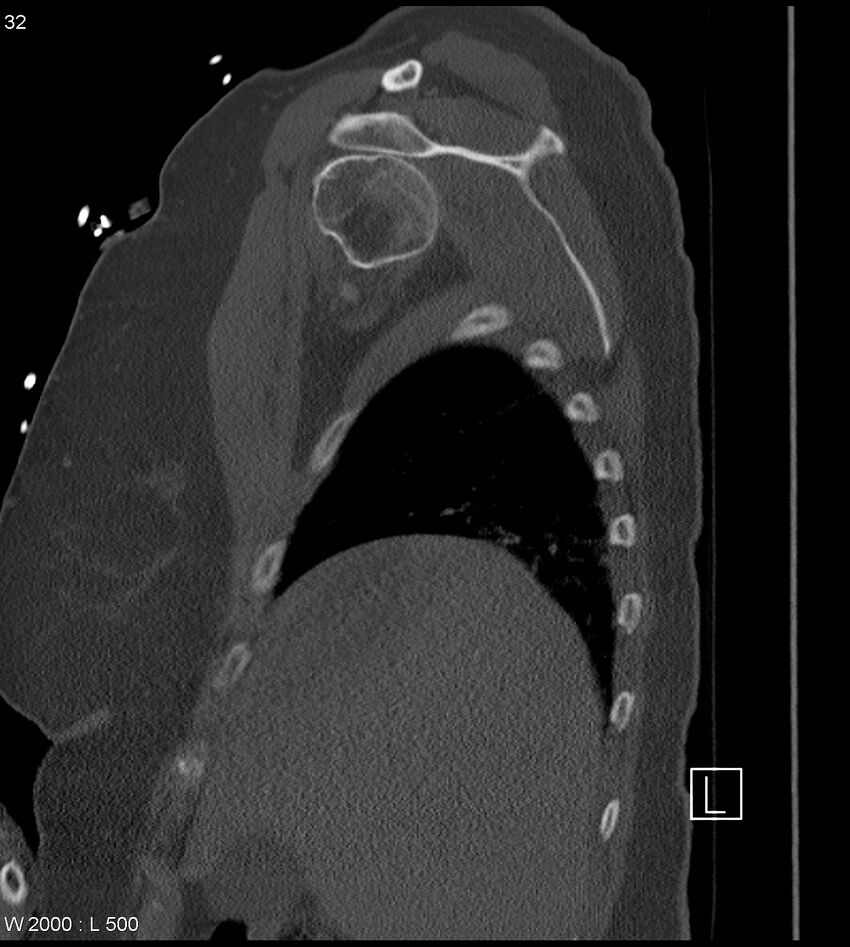Anterior shoulder dislocation (CT) (Radiopaedia 59032-66309 Sagittal bone window 16).jpg