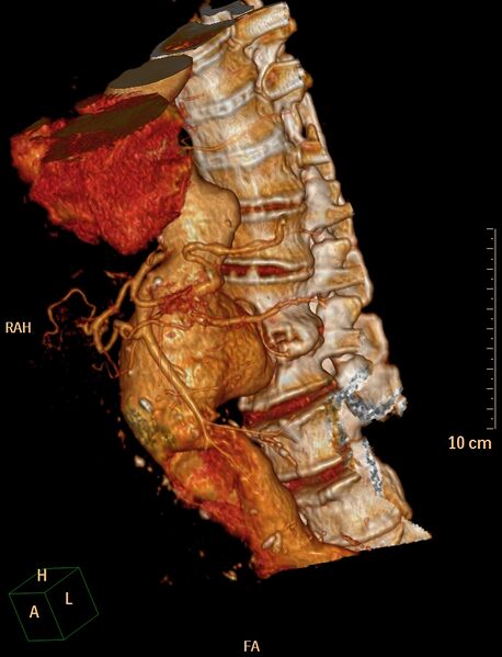 File:Anterior vertebral scalloping (abdominal aortic aneurysm) (Radiopaedia 66744-76067 B 2).jpg