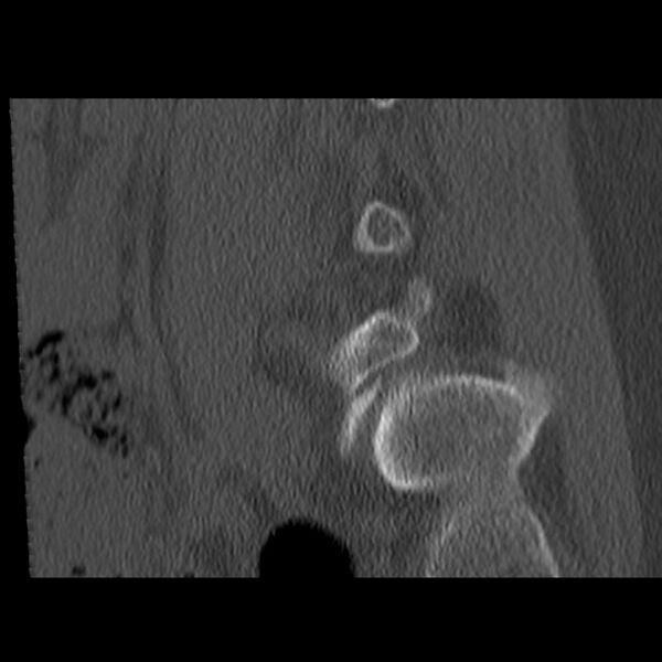 File:Anterolisthesis (Radiopaedia 22226-22263 Sagittal bone window 2).jpg
