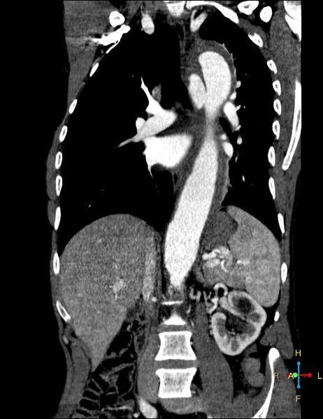 File:Aortic aneurysm and penetrating ulcer (Radiopaedia 23590-23704 B 10).jpg