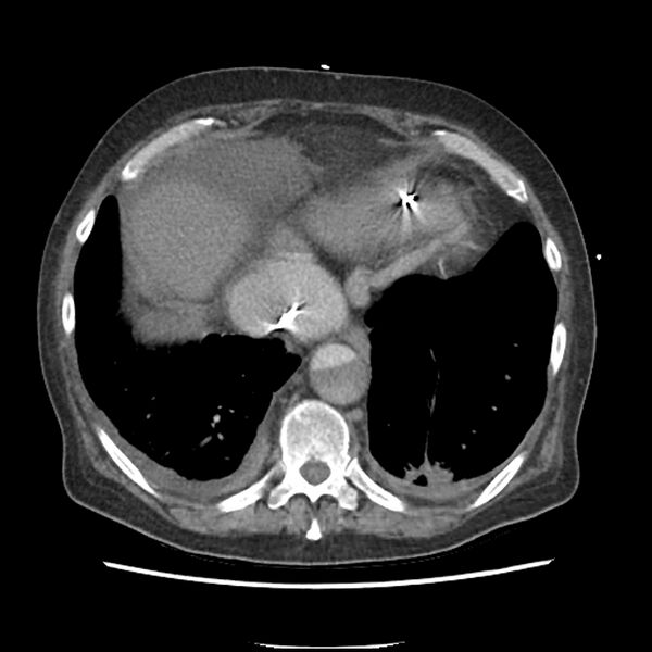 File:Aortic arch graft infection (FDG PET-CT) (Radiopaedia 71975-82437 A 50).jpg
