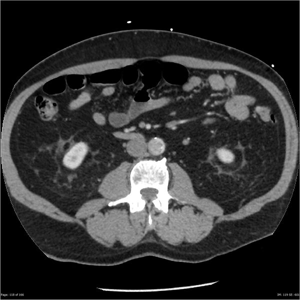 File:Aortic dissection- Stanford A (Radiopaedia 37759-39664 A 109).jpg