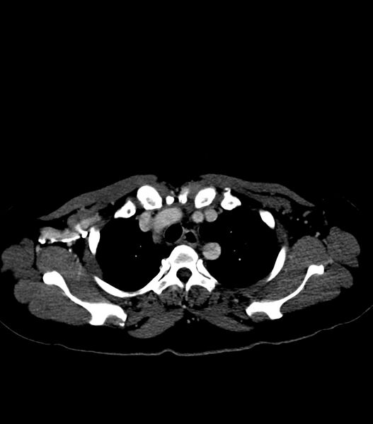 File:Aortic dissection with renal ischemia (Radiopaedia 76573-88338 B 6).jpg