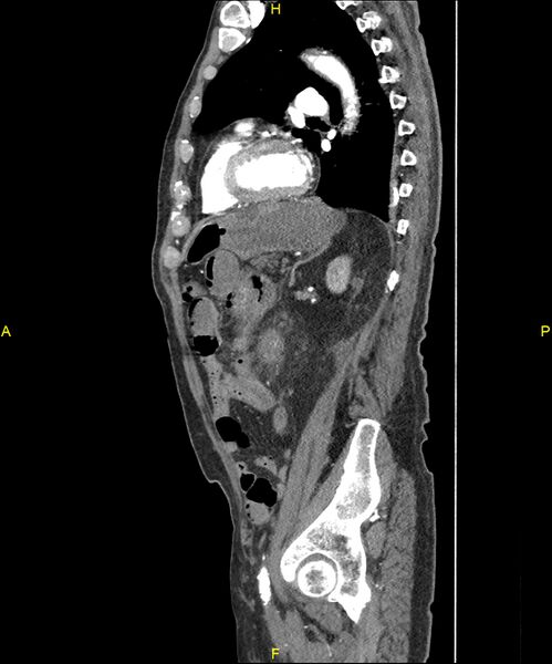 File:Aortoenteric fistula (Radiopaedia 84308-99603 C 229).jpg