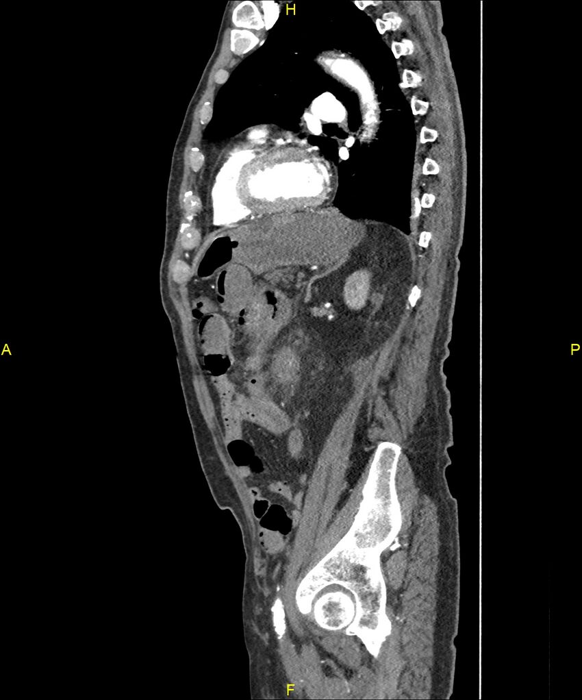 Aortoenteric fistula (Radiopaedia 84308-99603 C 229).jpg
