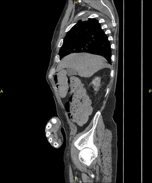 File:Aortoenteric fistula (Radiopaedia 84308-99603 C 72).jpg