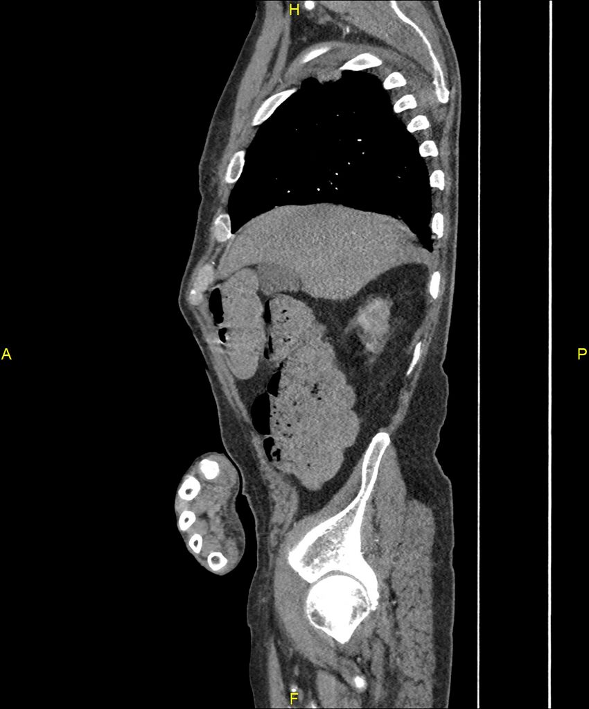 Aortoenteric fistula (Radiopaedia 84308-99603 C 72).jpg