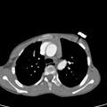 Aortopulmonary window, interrupted aortic arch and large PDA giving the descending aorta (Radiopaedia 35573-37074 B 26).jpg
