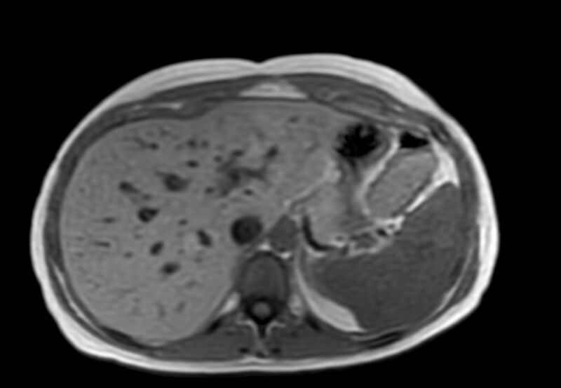File:Appendicitis in gravida (MRI) (Radiopaedia 89433-106395 Axial T1 in-phase 10).jpg