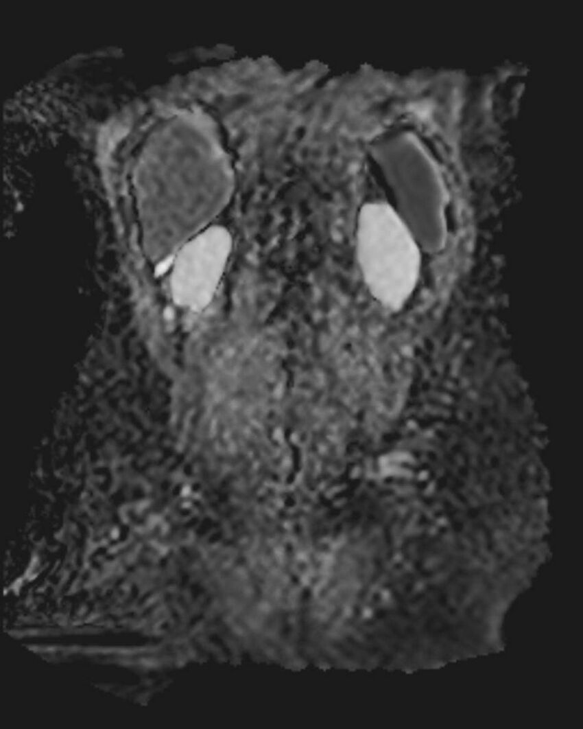 Appendicitis in gravida (MRI) (Radiopaedia 89433-106395 Coronal ADC 48).jpg