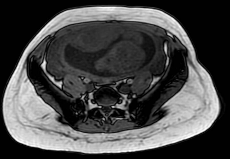 File:Appendicitis in gravida (MRI) (Radiopaedia 89433-106395 D 48).jpg