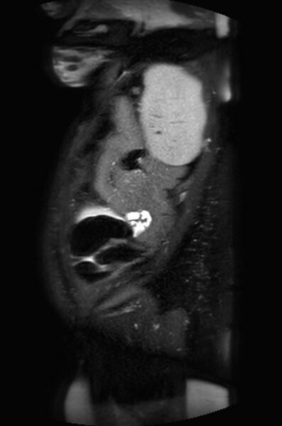 File:Appendicitis in gravida (MRI) (Radiopaedia 89433-106395 Sagittal T2 SPAIR 8).jpg