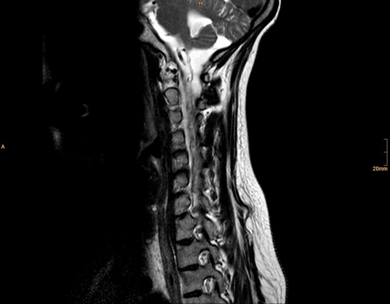 File:Arachnoid cyst - spinal (Radiopaedia 10055-10597 T2 10).jpg