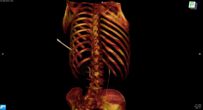 File:Arrow injury to the chest (Radiopaedia 75223-86321 3D bone 25).jpg