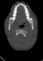 Arrow injury to the head (Radiopaedia 75266-86388 Axial bone window 28).jpg