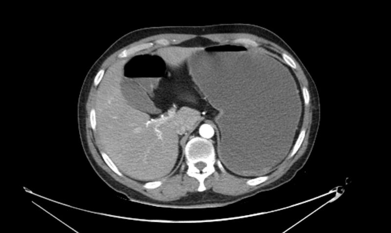 File:Arterial occlusive mesenteric ischemia (Radiopaedia 84641-100060 A 33).jpg
