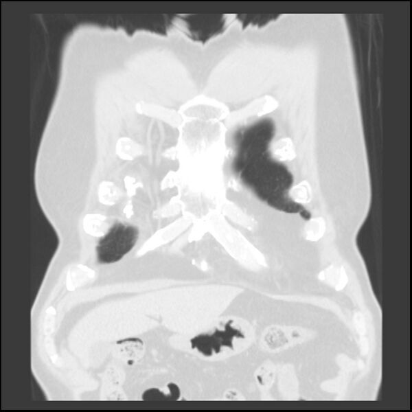 File:Asbestos-related pleural plaques (Radiopaedia 39069-41255 Coronal lung window 78).jpg