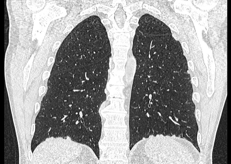 File:Asbestos pleural placques (Radiopaedia 57905-64872 Coronal lung window 216).jpg