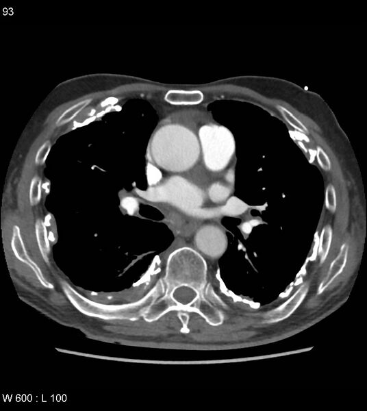 File:Asbestos related lung and pleural disease (Radiopaedia 14377-14301 D 29).jpg