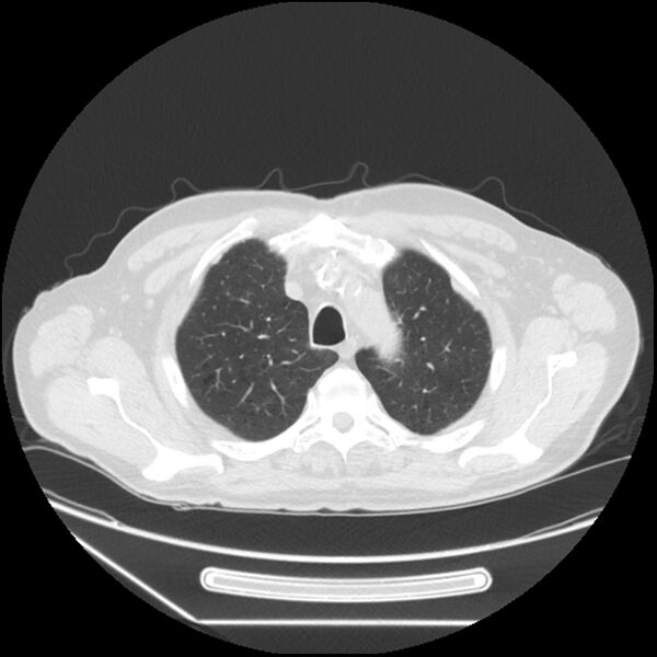 File:Asbestosis complicated by lung cancer (Radiopaedia 45834-50116 Axial lung window 14).jpg