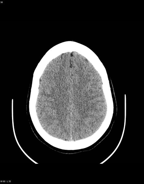 File:Astroblastoma (Radiopaedia 39792-42216 Axial non-contrast 35).jpg