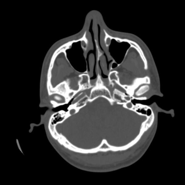 File:Asymptomatic occipital spur (Radiopaedia 87753-104201 Axial bone window 27).jpg
