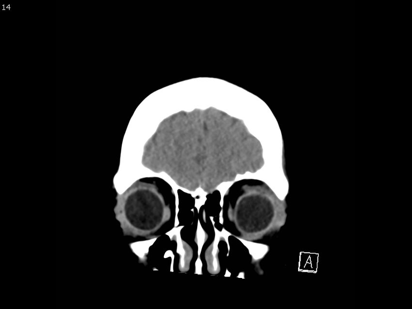 Atypical meningioma - intraosseous (Radiopaedia 64915-73867 B 13).jpg