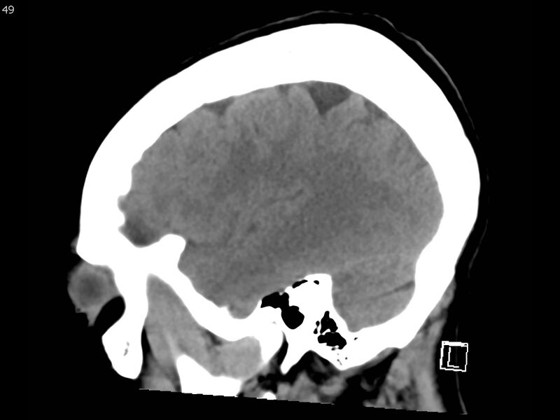 File:Atypical meningioma - intraosseous (Radiopaedia 64915-73867 C 47).jpg