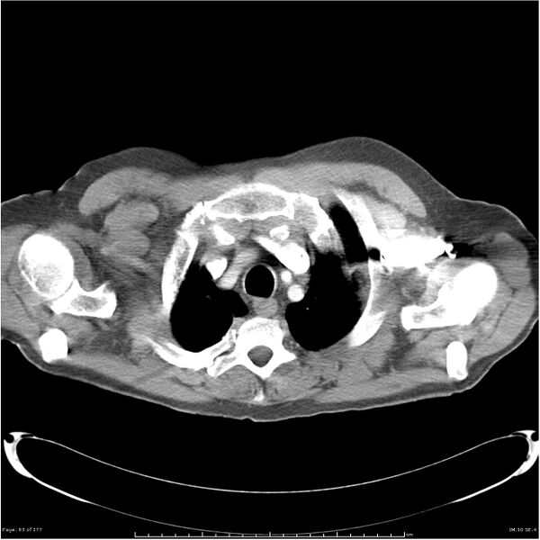 File:Atypical pneumonia - Q fever (Radiopaedia 21993-21989 C+ arterial phase 5).jpg